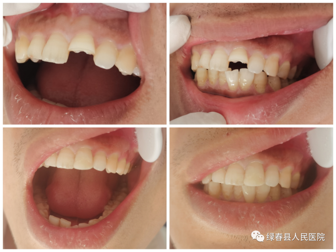 患者上前牙牙冠折断，行树脂修复牙冠，让患者牙齿全貌恢复如初