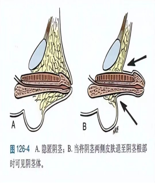 新技术丨我院成功开展首例隐匿性阴茎延长术