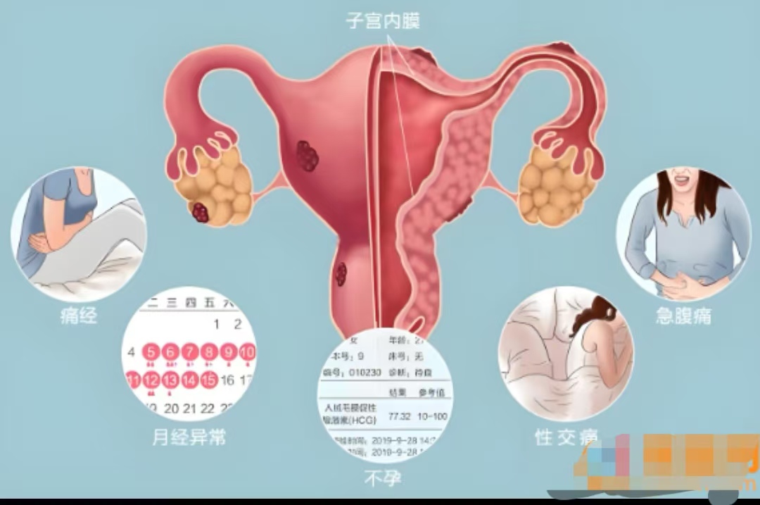 破解 “神秘疼痛” 密码：认识子宫内膜异