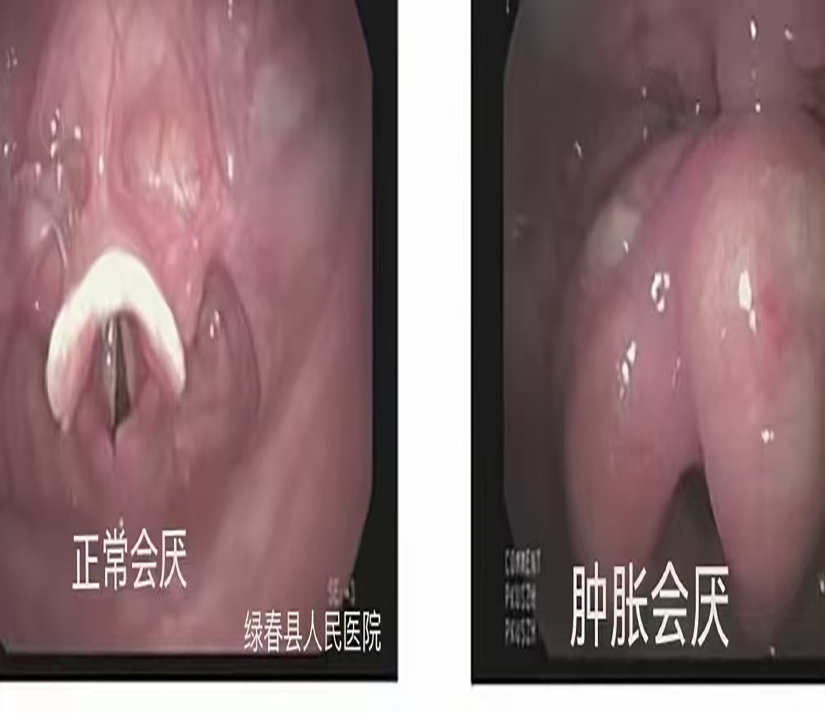 警惕喉咙里的"隐形杀手"——急性会厌炎急