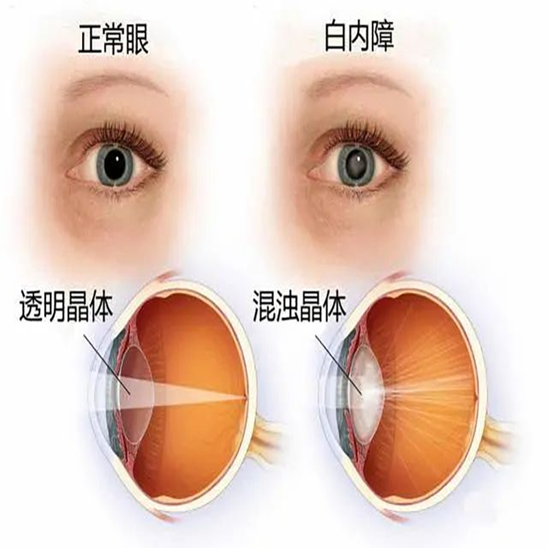 【科普】眼健康两大威胁：白内障和青光眼