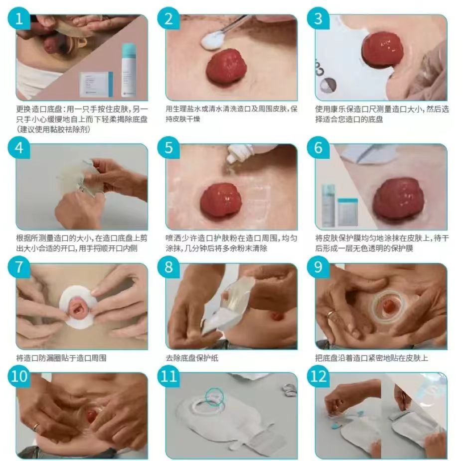 守护腹壁上的“玫瑰花”——肠造口护理：让生命在逆境中绽放